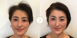 ビフォーアフター写真