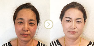 ビフォーアフター写真