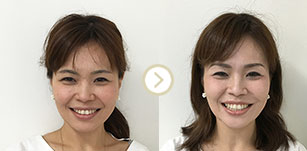 ビフォーアフター写真
