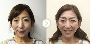 ビフォーアフター写真